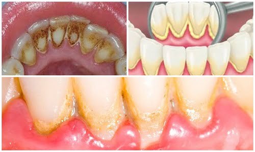 Nắm bắt 3 tiêu chí nào để biết lấy cao răng ở đâu an toàn? 1 Nắm bắt 3 tiêu chí nào để biết lấy cao răng ở đâu an toàn? 1