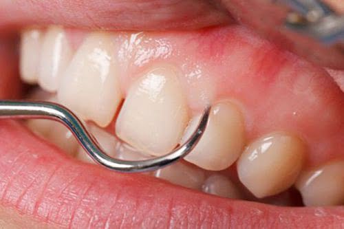 Thực hiện lấy cao răng có ảnh hưởng không? 2 Thực hiện lấy cao răng có ảnh hưởng không? 2