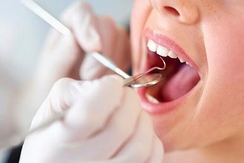 Quá trình lấy cao răng có đau hay không? Nhờ chuyên gia tư vấn 2