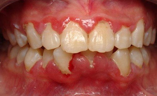Bị viêm chân răng có nguy hiểm không? Cần lưu ý gì? 1