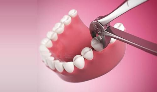 Nhổ răng hàm không đau có đúng không? 1