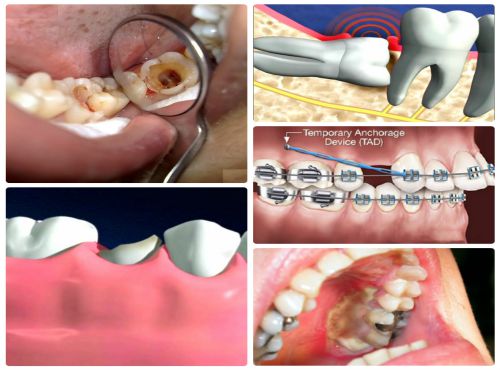 Nhổ răng hàm không đau có đúng không? 2