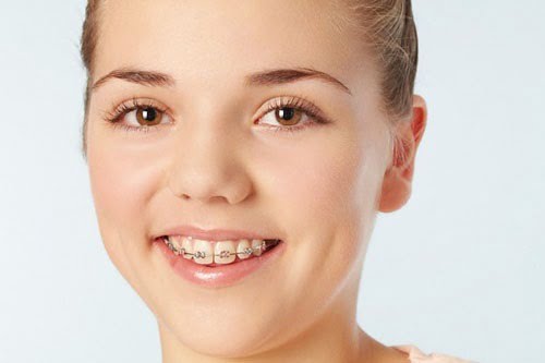 Làm răng sứ có niềng răng được không? Nha khoa tư vấn