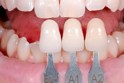 Làm răng sứ có niềng răng được không? Nha khoa tư vấn