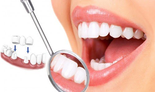 Làm răng sứ thẩm mỹ loại nào tốt? Đặc điểm nổi bật