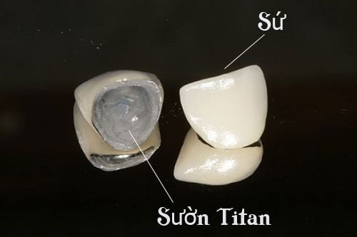 Răng sứ titan có mấy loại được sử dụng nhiều nhất hiện nay