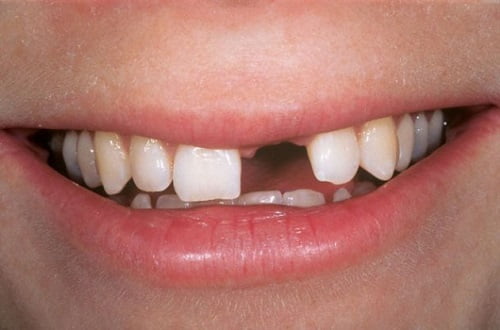Trồng răng cửa hàm trên được thực hiện như thế nào? 1