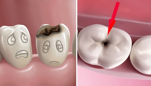 Răng sứ có bị sâu không? Cần lưu ý gì khi làm răng sứ