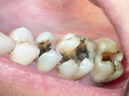 Răng sứ có bị sâu không? Cần lưu ý gì khi làm răng sứ