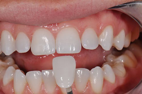 Răng sứ có tháo ra được không? Những tình trạng cần tháo răng sứ