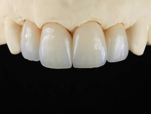 Răng sứ có trám được không khi bị mẻ vỡ?