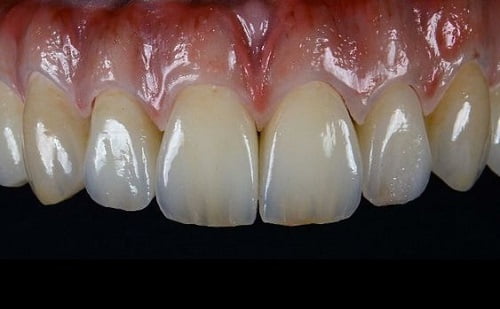 Răng sứ có trám được không khi bị mẻ vỡ?-2 Răng sứ có trám được không khi bị mẻ vỡ?