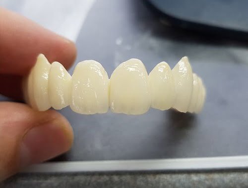Răng sứ có trám được không khi bị mẻ vỡ?