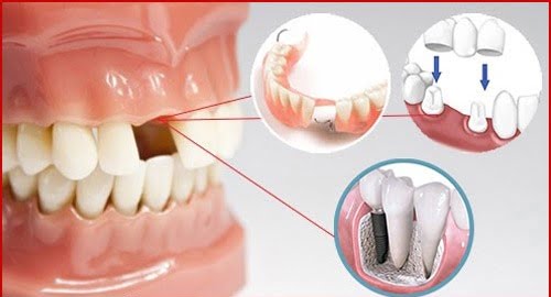 Trồng răng cấm hết bao nhiêu tiền hiện nay? 2 Trồng răng cấm hết bao nhiêu tiền hiện nay? 2