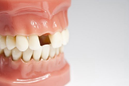 Trồng răng hàm implant giá bao nhiêu? Nha khoa chia sẻ 1