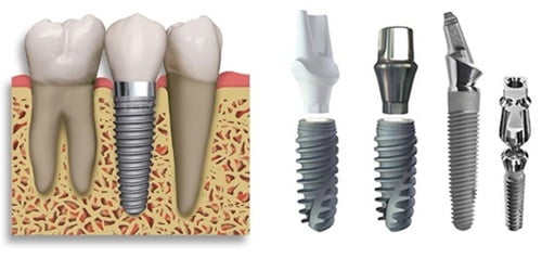 Trồng răng implant có bền chắc không?