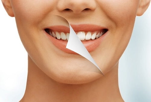 Có nên tẩy trắng răng nhiều lần? Lý giải từ chuyên gia 1