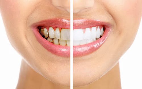 Có nên tẩy trắng răng nhiều lần? Lý giải từ chuyên gia 2 Có nên tẩy trắng răng nhiều lần? Lý giải từ chuyên gia 2