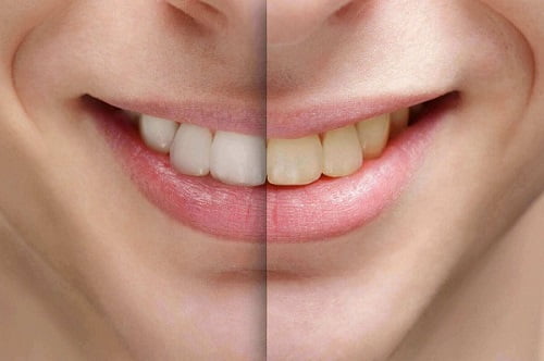 Có nên tẩy trắng răng nhiều lần? Lý giải từ chuyên gia 3