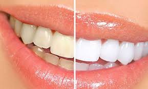 Tẩy trắng răng bằng than hoạt tính an toàn