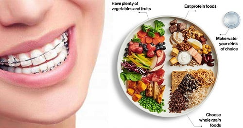 Niềng răng ăn uống như thế nào là tốt nhất? 3
