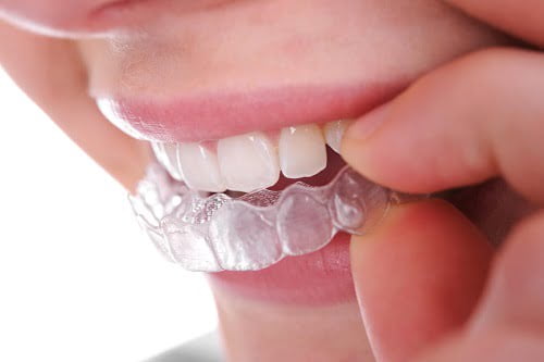 Niềng răng bao lâu thì nên có bầu? Bác sĩ giải đáp 1