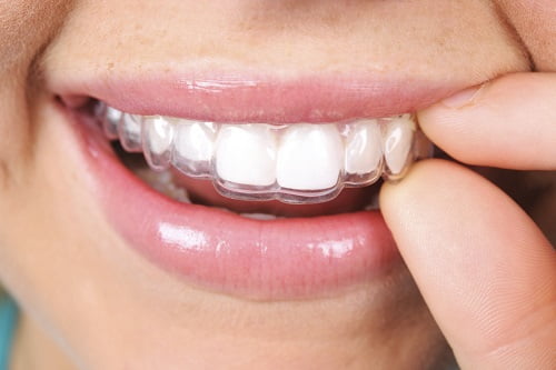 Niềng răng bao lâu thì nên có bầu? Bác sĩ giải đáp 2