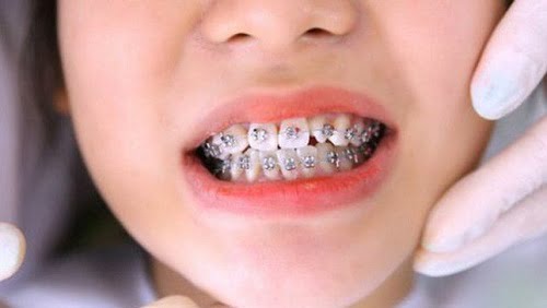 Niềng răng chỉnh hàm lệch lạc hiệu quả cao không? 1