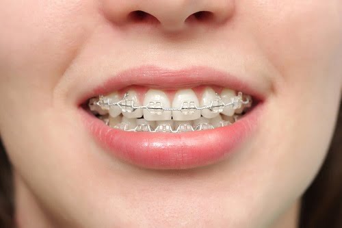 Niềng răng có hại cho sức khỏe không? Tìm hiểu ngay 1