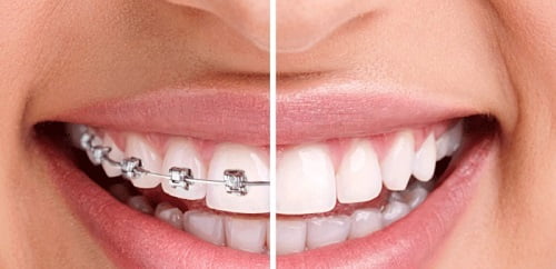 Niềng răng có hại cho sức khỏe không? Tìm hiểu ngay 2