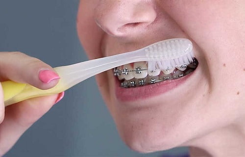 Niềng răng dùng bàn chải gì là hợp lý? 1