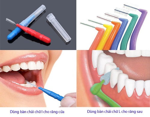 Niềng răng dùng bàn chải gì là hợp lý? 2