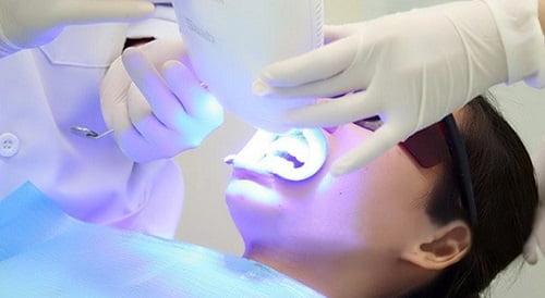 Tẩy trắng răng xong có được đánh răng không? Lý do 2