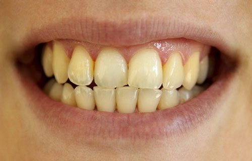 Cách tẩy trắng răng bị ố vàng tại nhà cho bạn 1 Cách tẩy trắng răng bị ố vàng tại nhà cho bạn 1