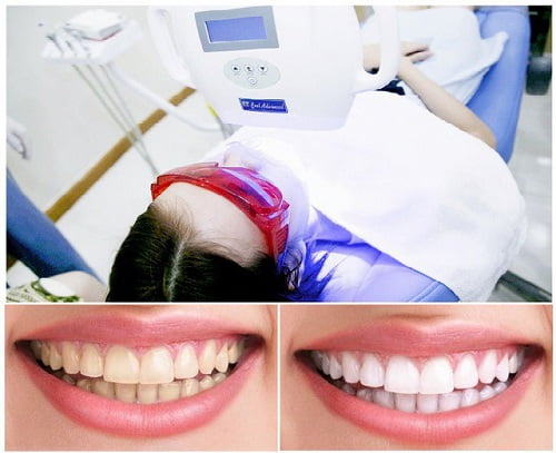 Cách tẩy trắng răng bị ố vàng tại nhà cho bạn 3 Cách tẩy trắng răng bị ố vàng tại nhà cho bạn 3