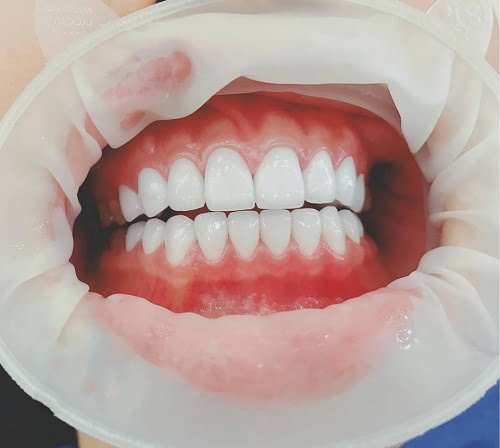 Răng sứ bị thưa - Cách khắc phục hiệu quả 1