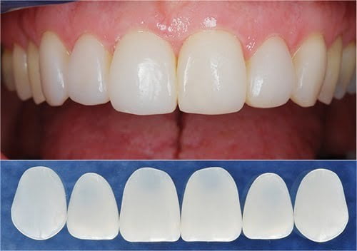 Làm răng sứ cả hàm áp dụng cho trường hợp nào? 2