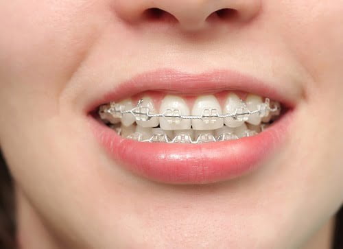 Niềng răng lúc nào đau nhất? Tìm hiểu từng giai đoạn 3