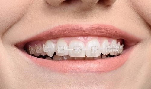 Niềng răng phải nhổ răng nào? Vì sao? 3