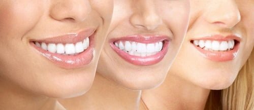 Tẩy trắng răng có nguy hiểm không? Thực hư thế nào? 1