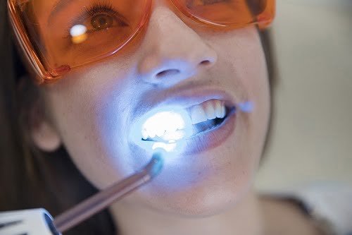 Tẩy trắng răng có nguy hiểm không? Thực hư thế nào? 2