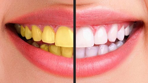 Tẩy trắng răng có nguy hiểm không? Thực hư thế nào? 3
