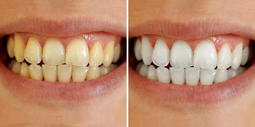 Tẩy trắng răng cho răng sâu có được không? Tham khảo 1