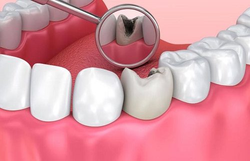 Tẩy trắng răng cho răng sâu có được không? Tham khảo 2