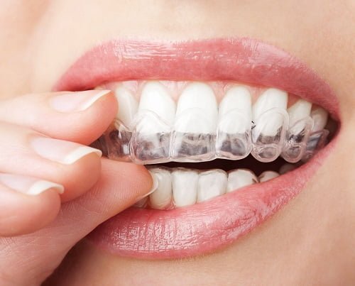 Niềng răng invisalign có nhổ răng không? Chuyên gia tư vấn 1