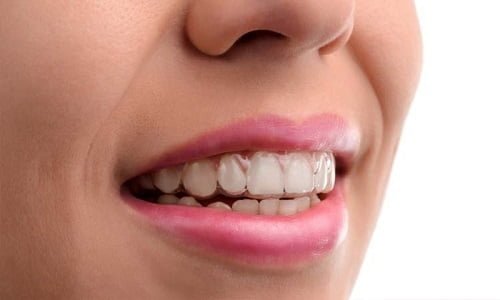 Niềng răng invisalign có nhổ răng không? Chuyên gia tư vấn 2