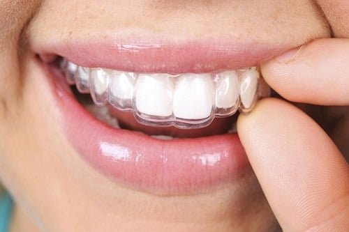 Niềng răng invisalign có nhổ răng không? Chuyên gia tư vấn 3