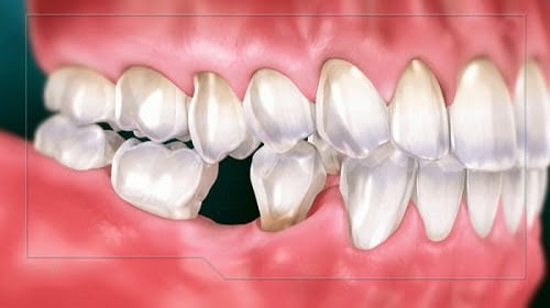 Trồng răng cối - Phương pháp phục hình phù hợp 1
