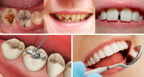 Răng bị vỡ có hàn được không? Chuyên gia giải đáp 3