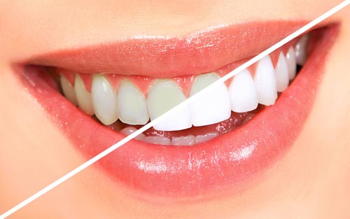 Tẩy trắng răng bằng máng có tốt không? Tìm hiểu cách thực hiện 3